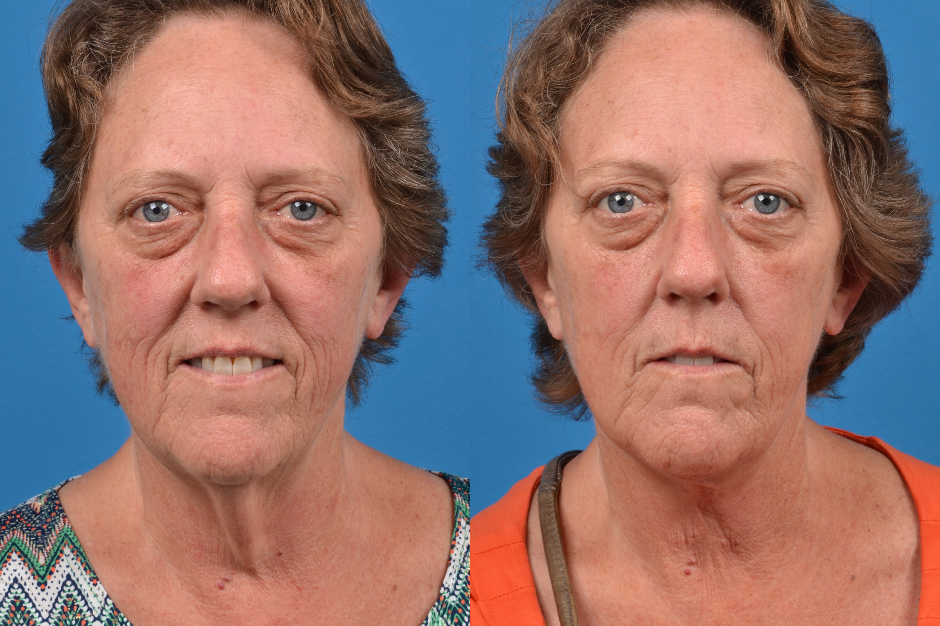 Profile Neck Lift Photos | Melbourne, FL | Patient 31316